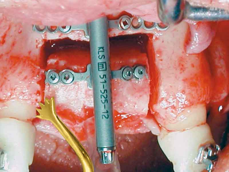 остеотомия больших участков кости во время челюстно-лицевой хирургии